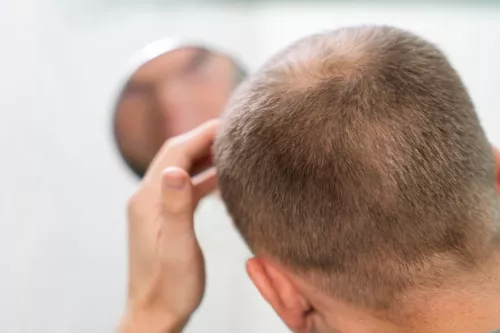 Chute de cheveux héréditaire homme : comprendre, prévenir, traiter